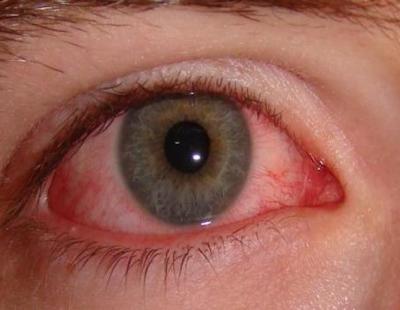علاجات فعالة للاحمرار المفاجئ في العين