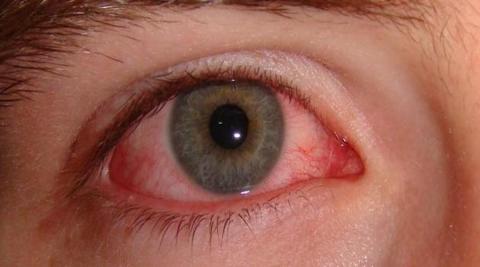 علاجات فعالة للاحمرار المفاجئ في العين