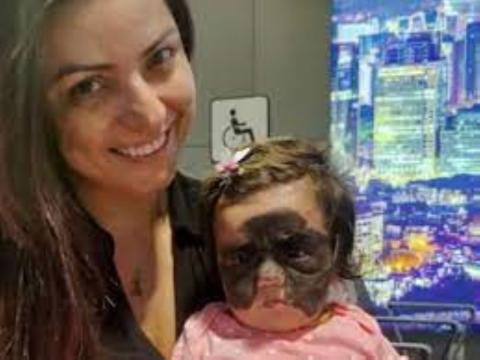  فريق طبي روسي يزيل وحمة " قناع باتمان " من وجه طفلة أمريكية بشكل آمن